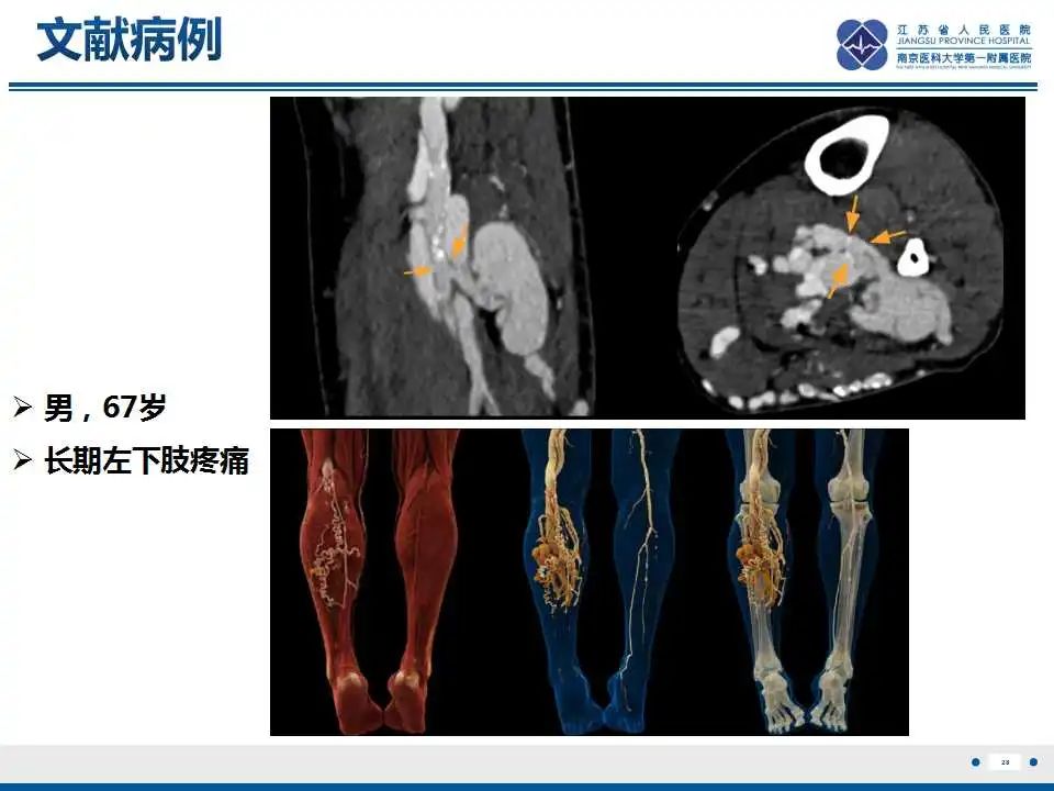 影像PPT - 【PPT】腺泡状软组织肉瘤-29