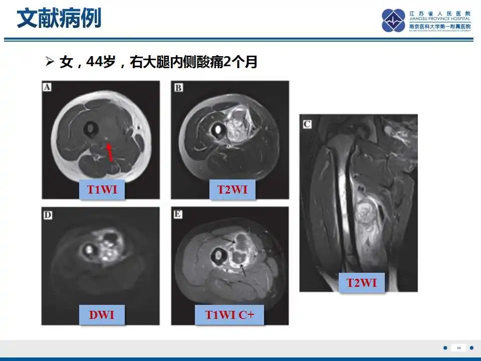 影像PPT - 【PPT】腺泡状软组织肉瘤-31