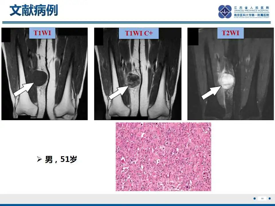 影像PPT - 【PPT】腺泡状软组织肉瘤-33