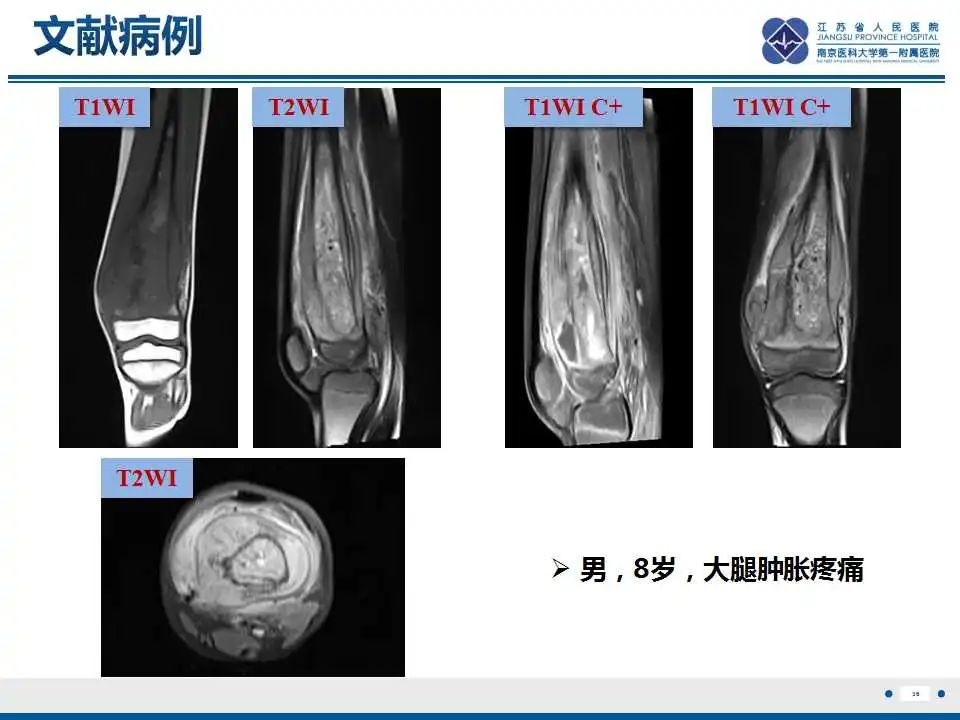 影像PPT - 【PPT】腺泡状软组织肉瘤-36