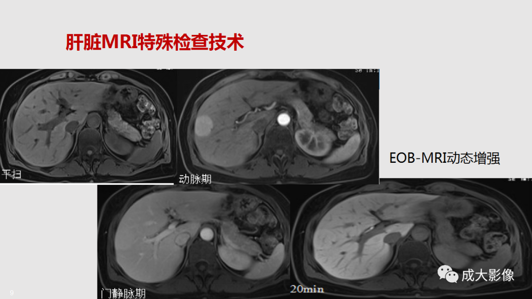 影像PPT - 【PPT】肝腺瘤影像诊断-7