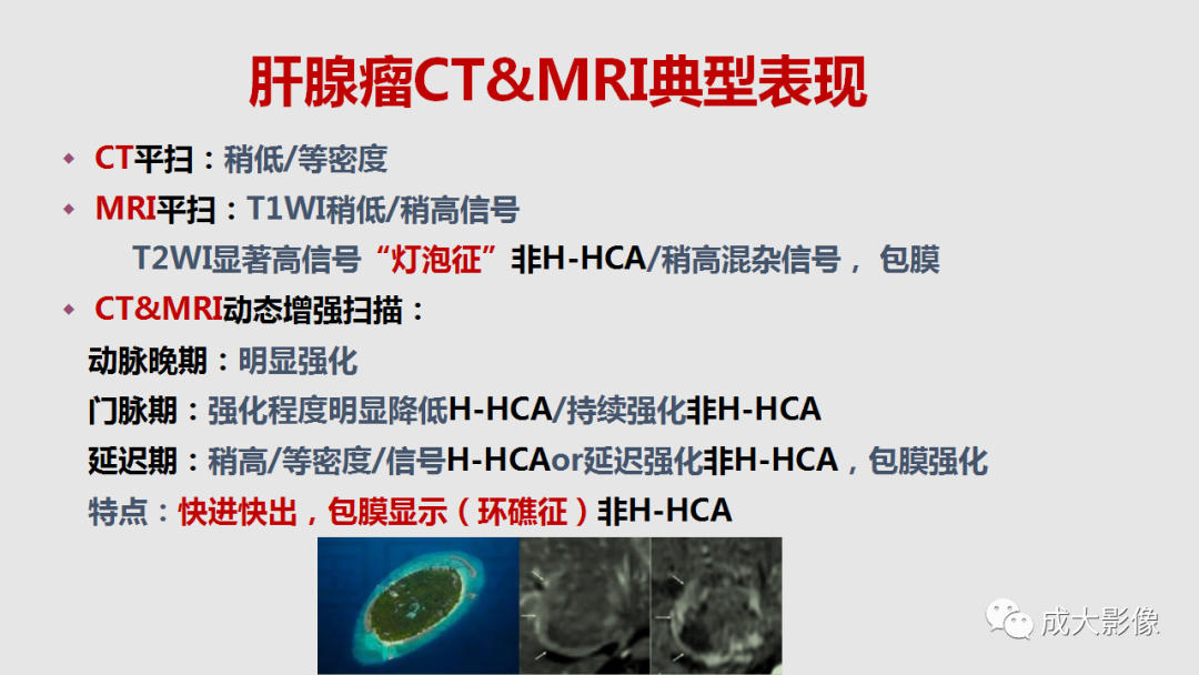 影像PPT - 【PPT】肝腺瘤影像诊断-9