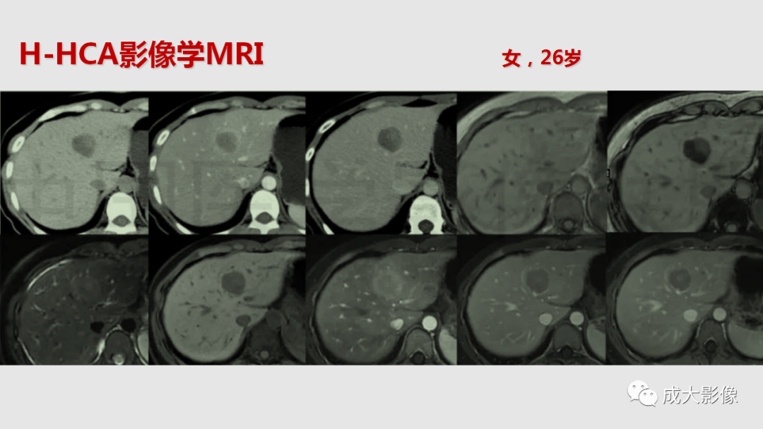 影像PPT - 【PPT】肝腺瘤影像诊断-15