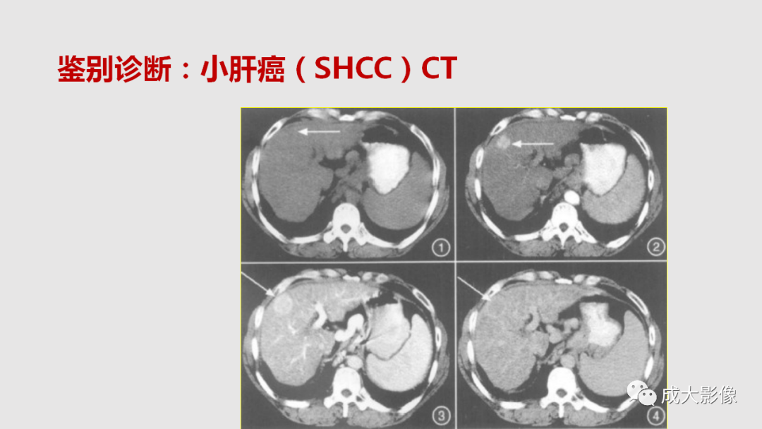 影像PPT - 【PPT】肝腺瘤影像诊断-31