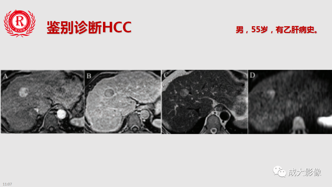 影像PPT - 【PPT】肝腺瘤影像诊断-29