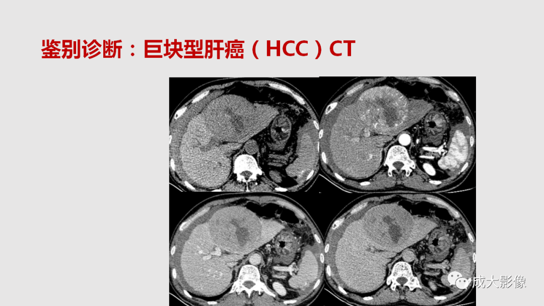 影像PPT - 【PPT】肝腺瘤影像诊断-32