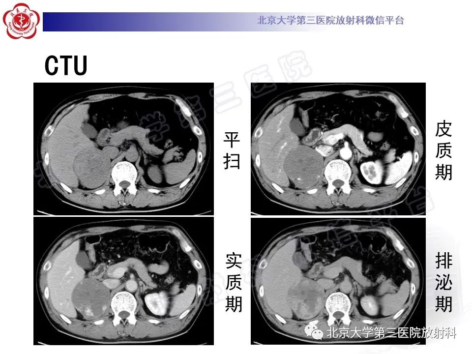 影像PPT - 【PPT】肾上腺血管瘤-3