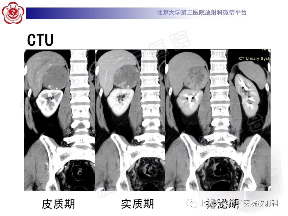 影像PPT - 【PPT】肾上腺血管瘤-4