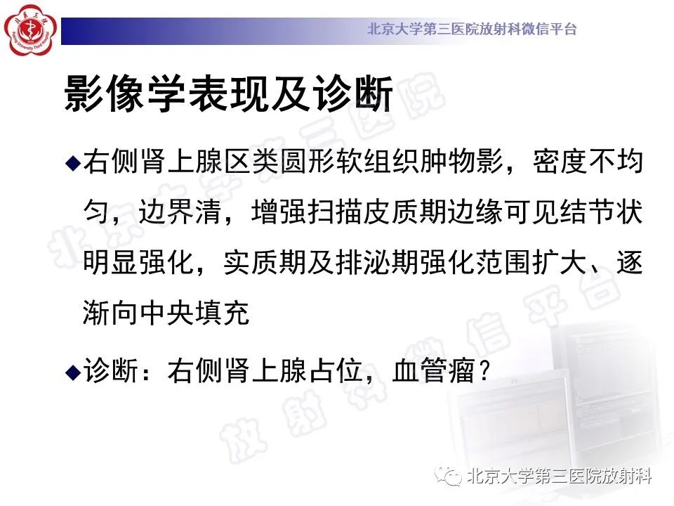 影像PPT - 【PPT】肾上腺血管瘤-5