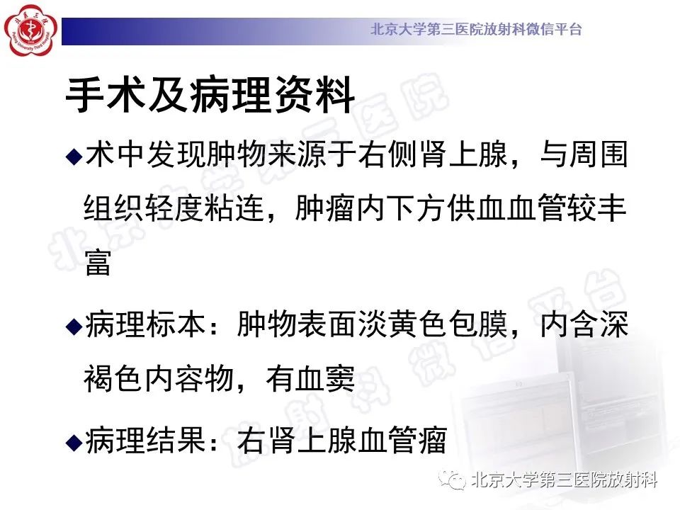 影像PPT - 【PPT】肾上腺血管瘤-6