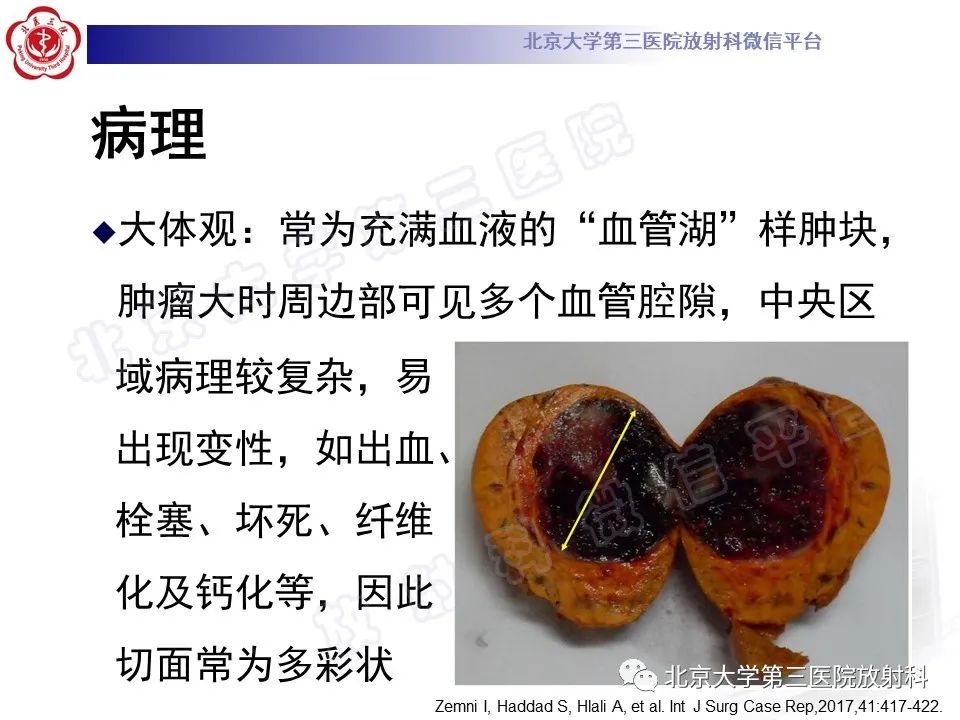 影像PPT - 【PPT】肾上腺血管瘤-11