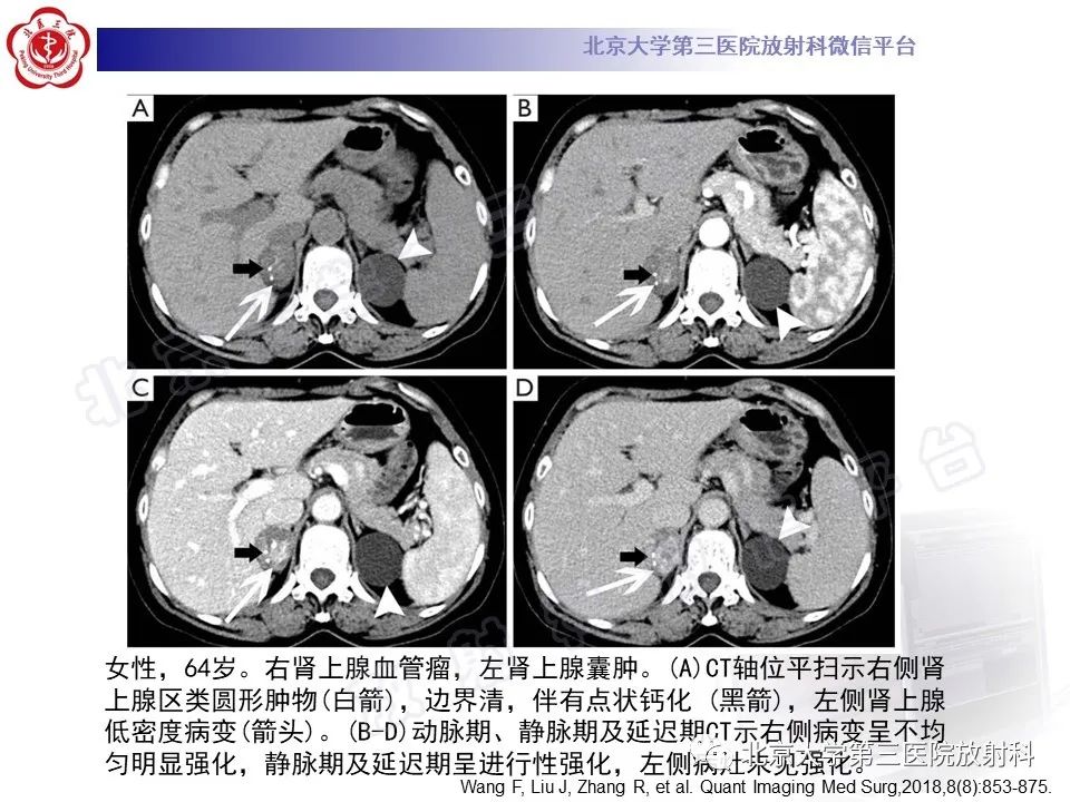 影像PPT - 【PPT】肾上腺血管瘤-16