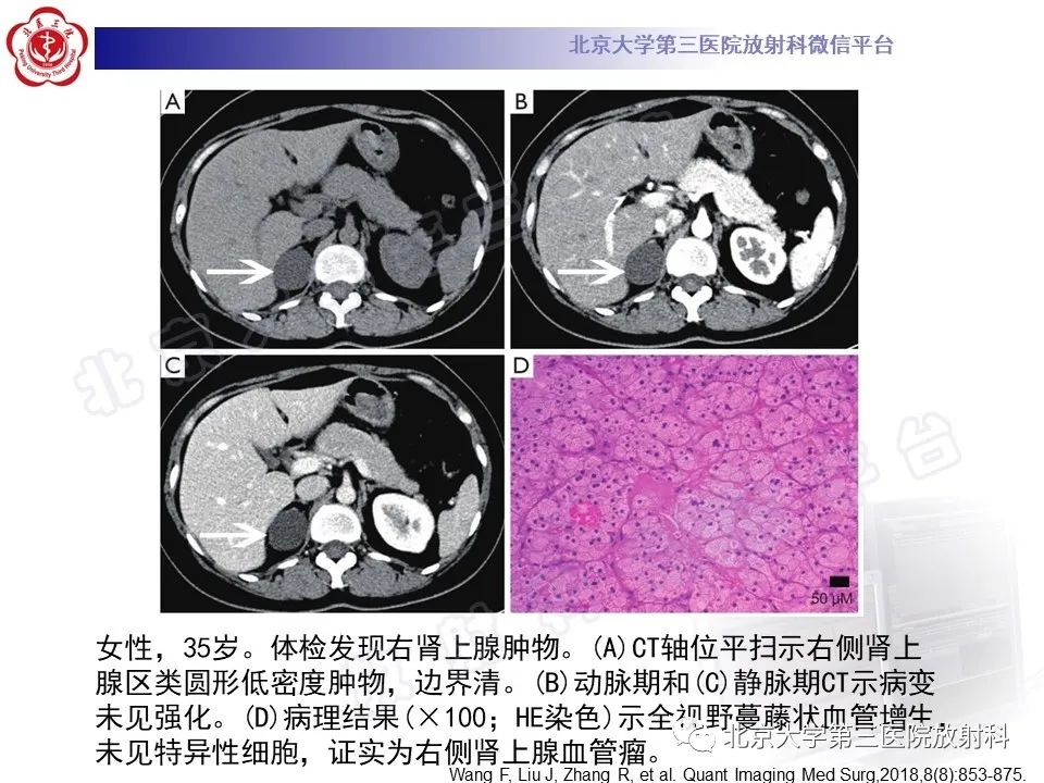 影像PPT - 【PPT】肾上腺血管瘤-17