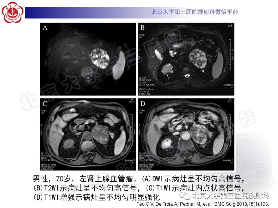 影像PPT - 【PPT】肾上腺血管瘤-18