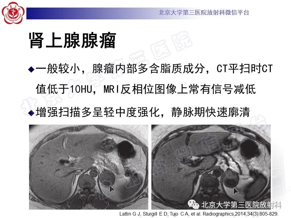 影像PPT - 【PPT】肾上腺血管瘤-20