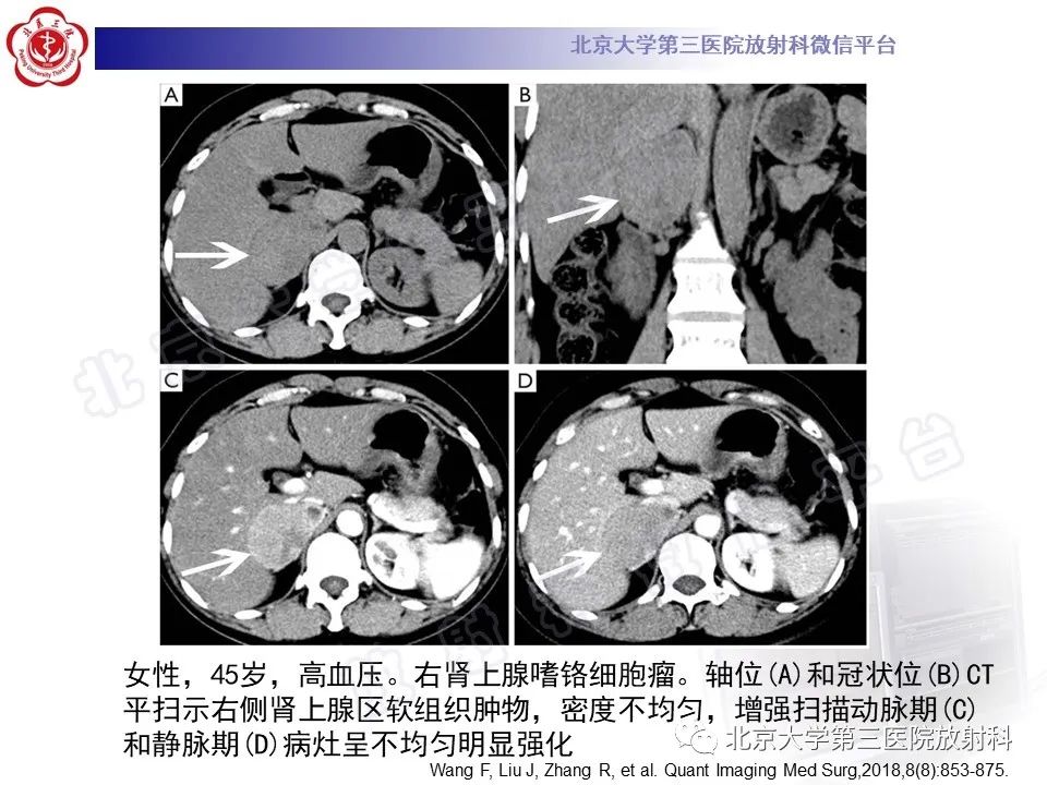 影像PPT - 【PPT】肾上腺血管瘤-22