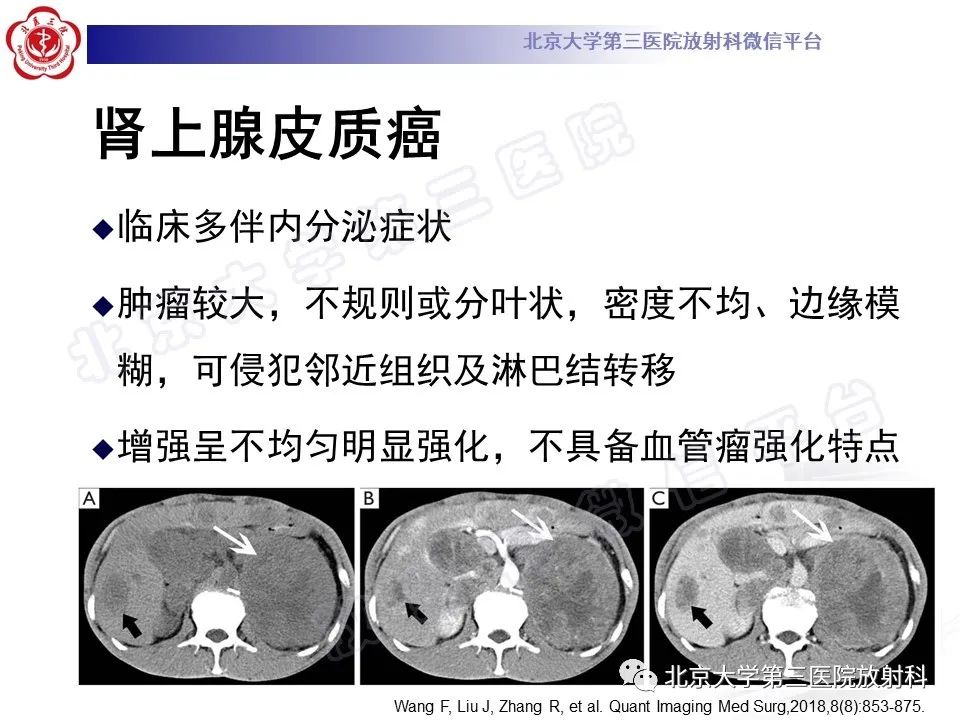 影像PPT - 【PPT】肾上腺血管瘤-23