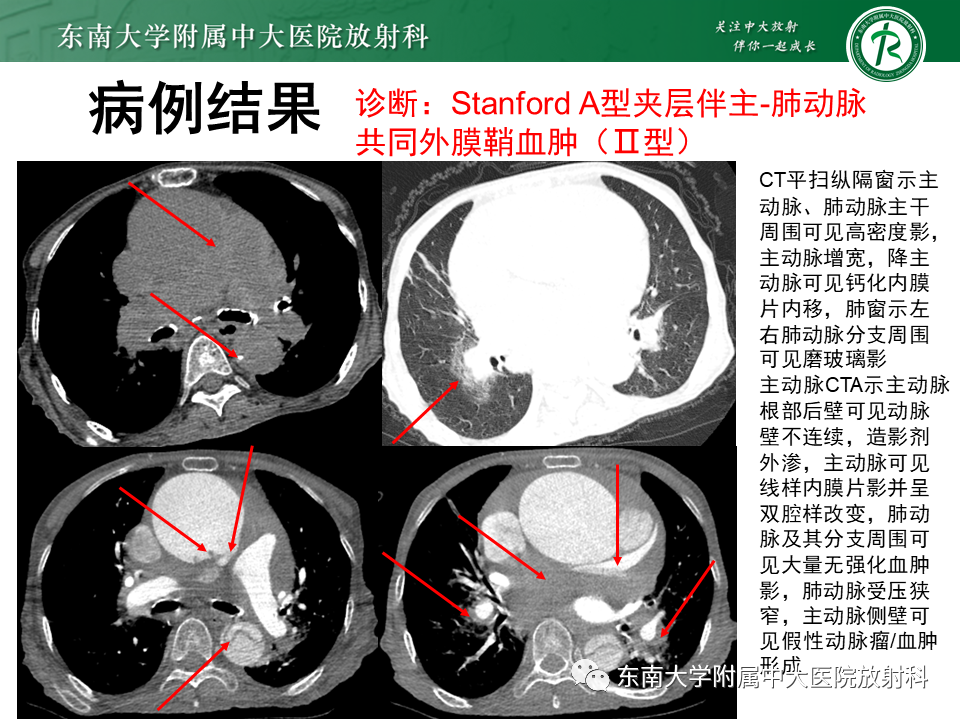 影像PPT - 【PPT】主-肺动脉共同外膜鞘血肿-2