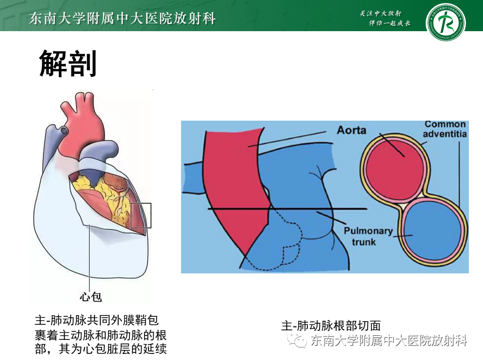 影像PPT - 【PPT】主-肺动脉共同外膜鞘血肿-6