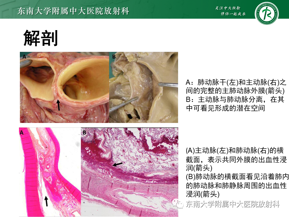 影像PPT - 【PPT】主-肺动脉共同外膜鞘血肿-7