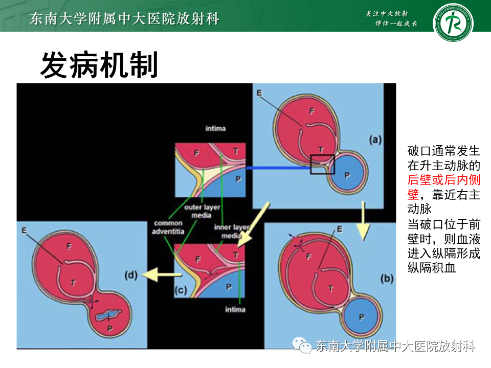 影像PPT - 【PPT】主-肺动脉共同外膜鞘血肿-9