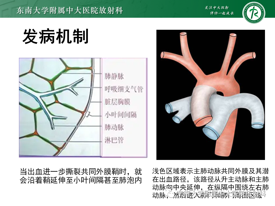 影像PPT - 【PPT】主-肺动脉共同外膜鞘血肿-10