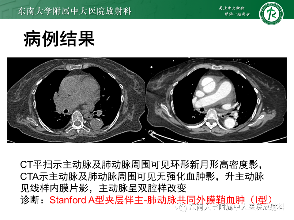 影像PPT - 【PPT】主-肺动脉共同外膜鞘血肿-16