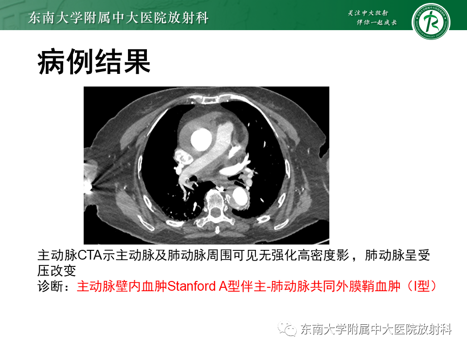 影像PPT - 【PPT】主-肺动脉共同外膜鞘血肿-19