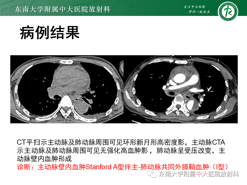 影像PPT - 【PPT】主-肺动脉共同外膜鞘血肿-22