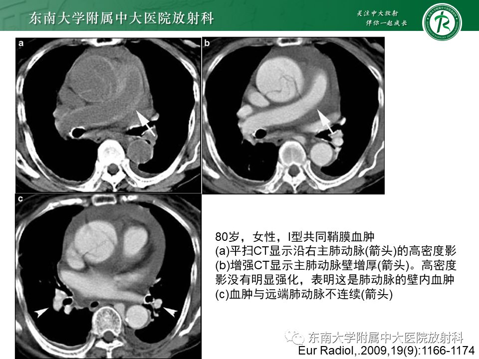 影像PPT - 【PPT】主-肺动脉共同外膜鞘血肿-24