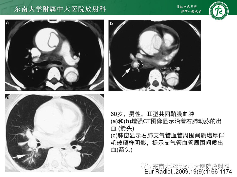 影像PPT - 【PPT】主-肺动脉共同外膜鞘血肿-25