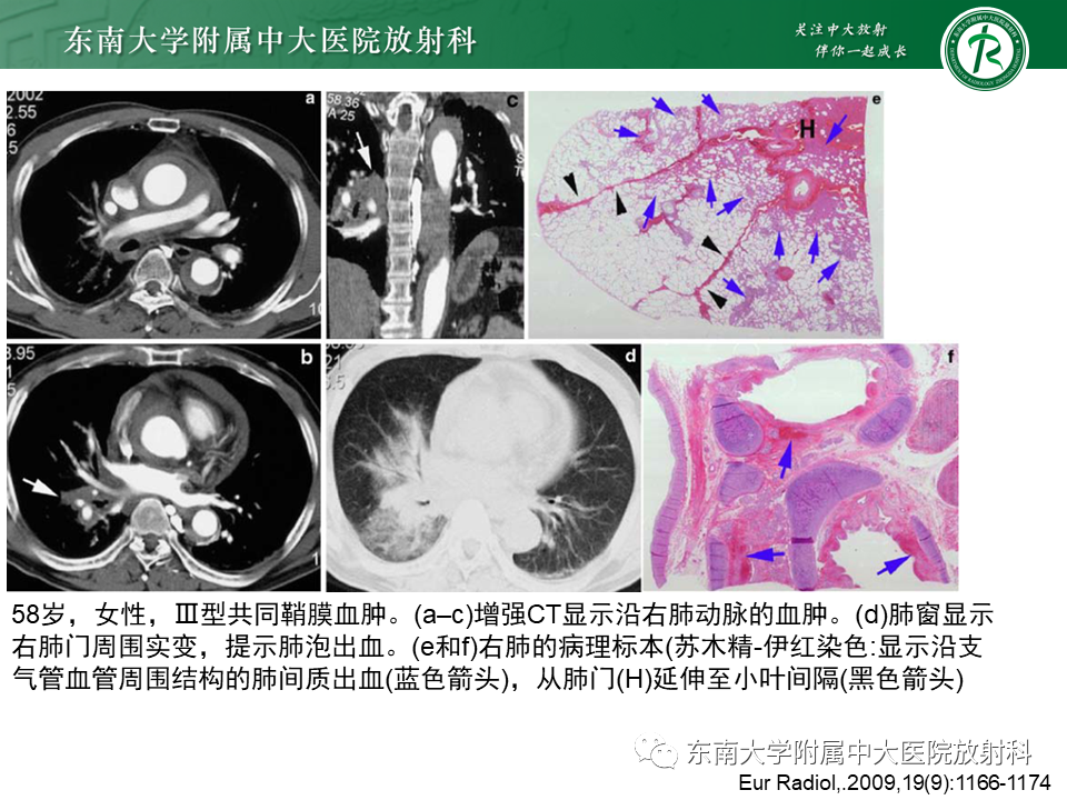 影像PPT - 【PPT】主-肺动脉共同外膜鞘血肿-26