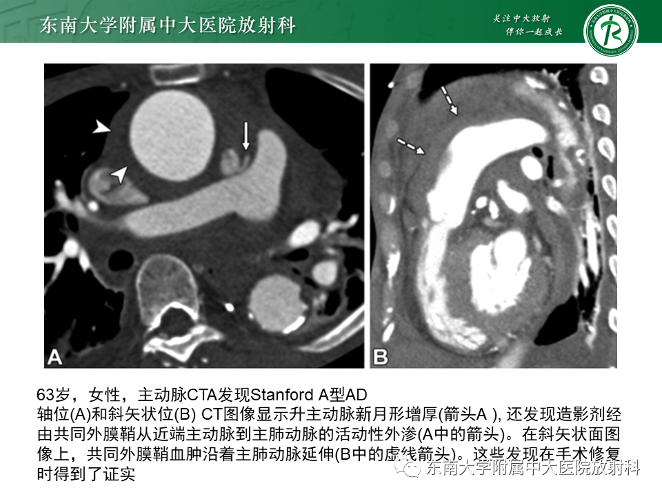 影像PPT - 【PPT】主-肺动脉共同外膜鞘血肿-27