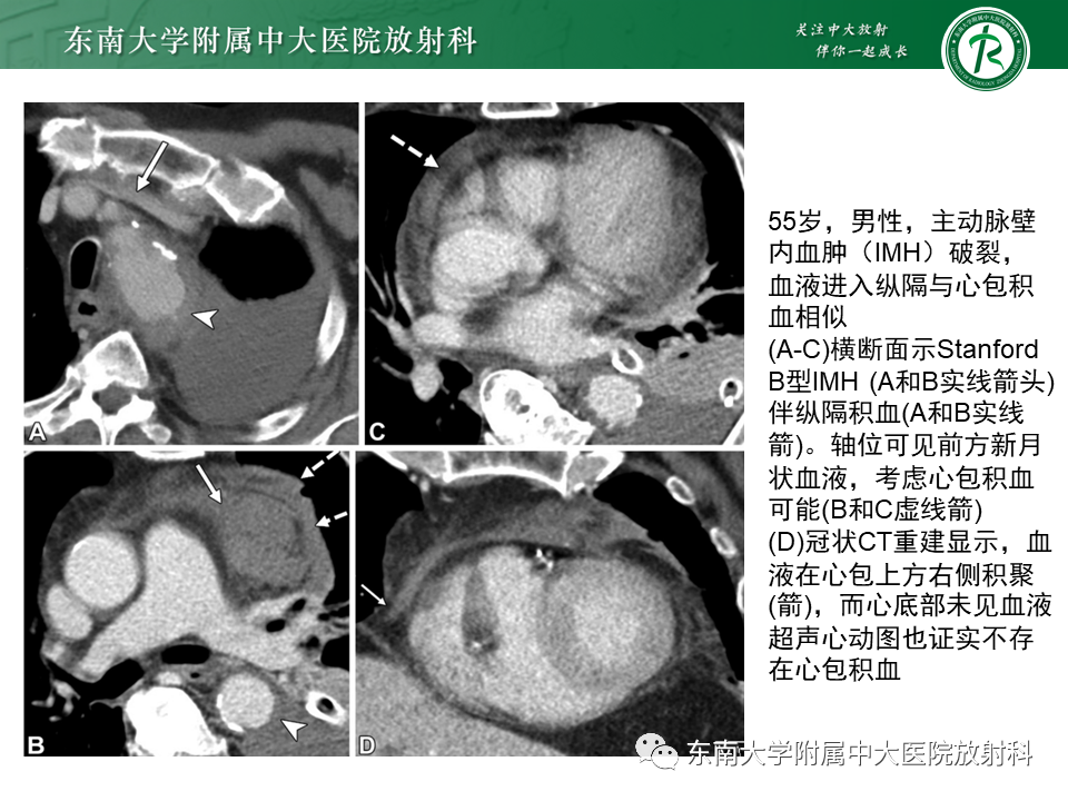 影像PPT - 【PPT】主-肺动脉共同外膜鞘血肿-29
