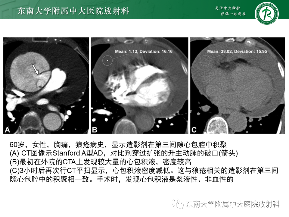 影像PPT - 【PPT】主-肺动脉共同外膜鞘血肿-30