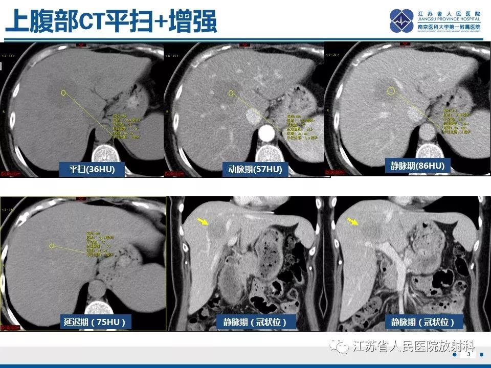 影像PPT - 【PPT】肝结核-4