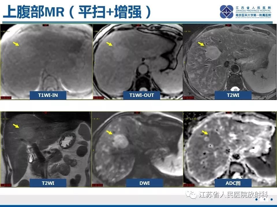 影像PPT - 【PPT】肝结核-5