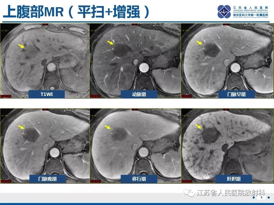 影像PPT - 【PPT】肝结核-6