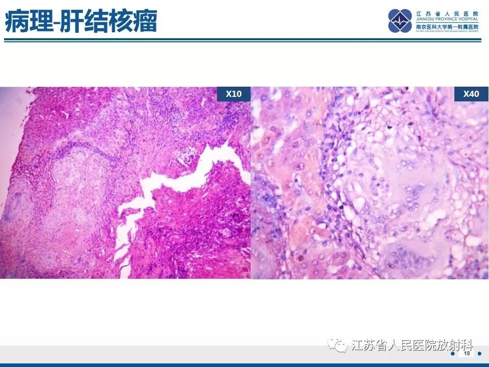 影像PPT - 【PPT】肝结核-19
