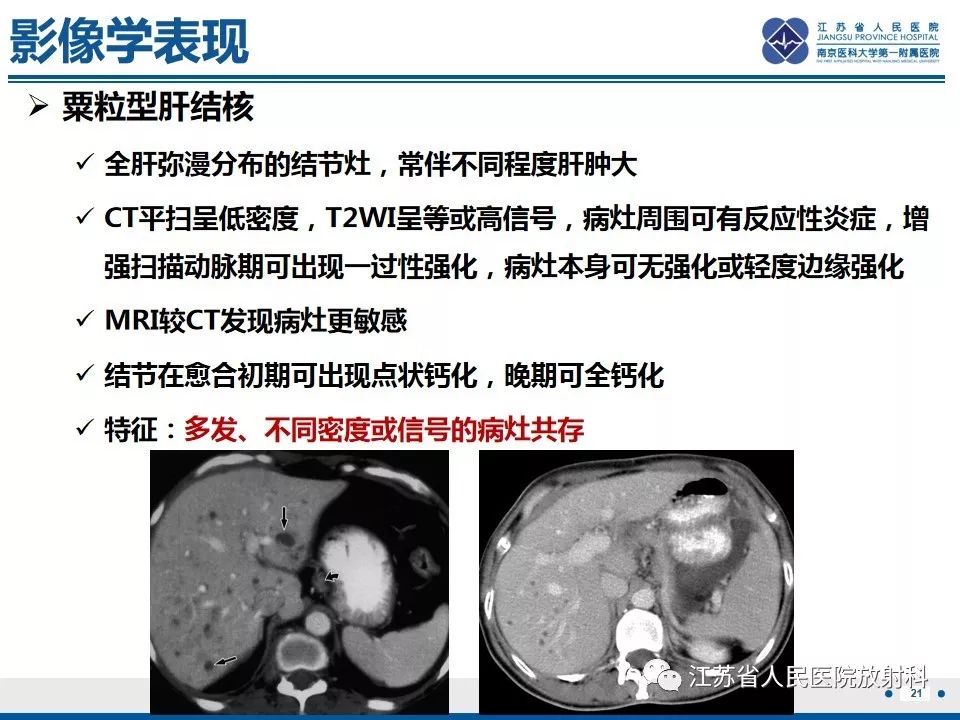 影像PPT - 【PPT】肝结核-22
