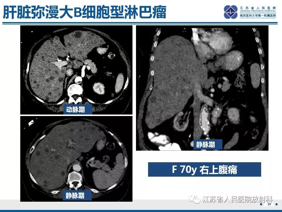 影像PPT - 【PPT】肝结核-29