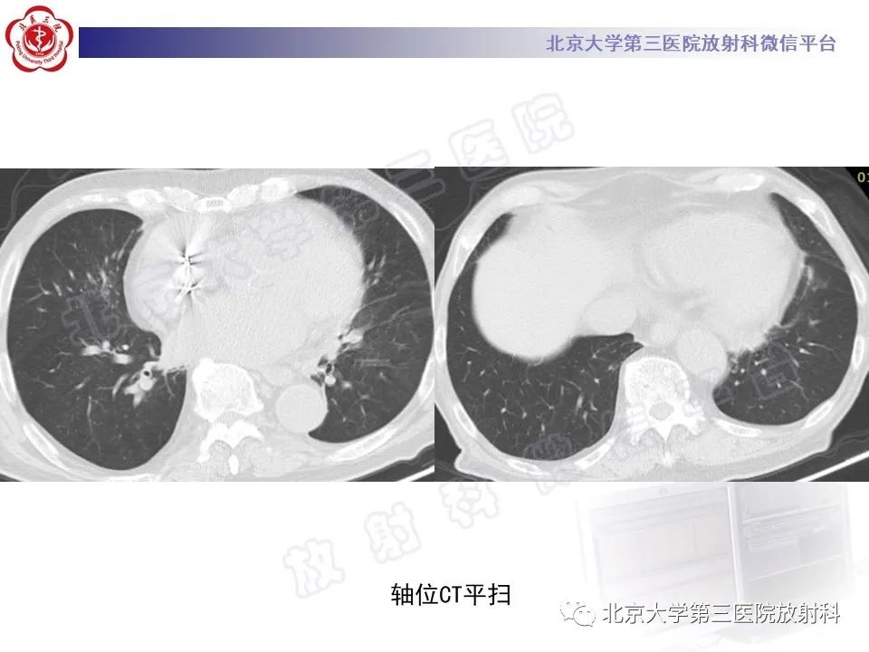 影像PPT - 【PPT】侵袭性肺曲霉菌病-8
