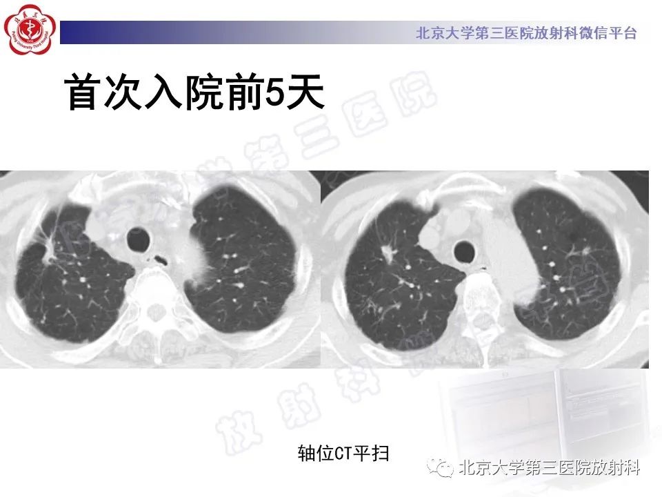影像PPT - 【PPT】侵袭性肺曲霉菌病-6
