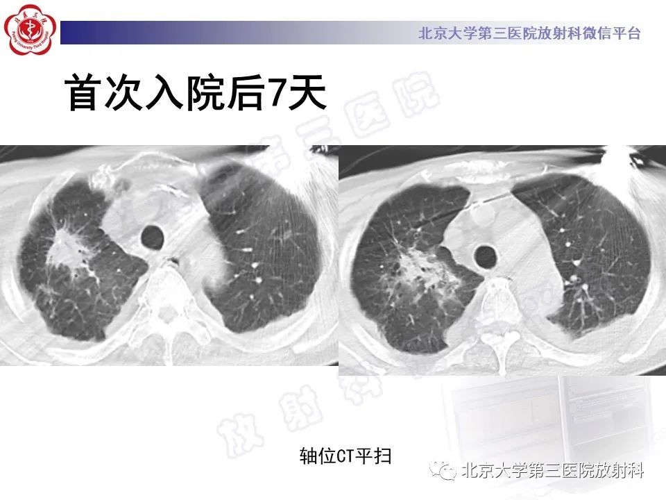 影像PPT - 【PPT】侵袭性肺曲霉菌病-10