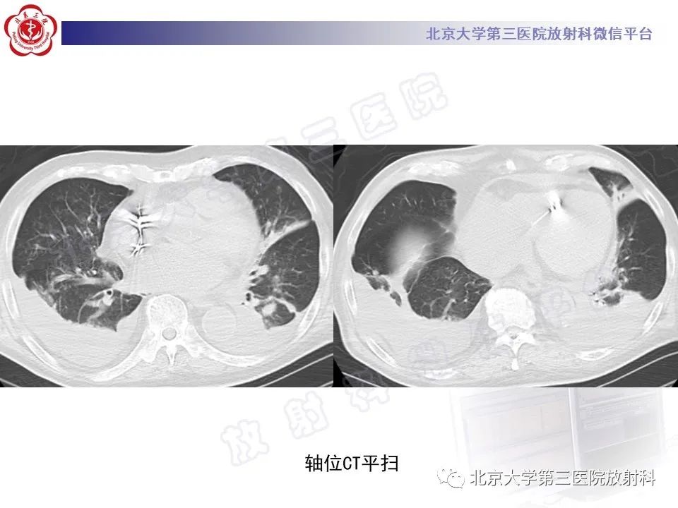 影像PPT - 【PPT】侵袭性肺曲霉菌病-12