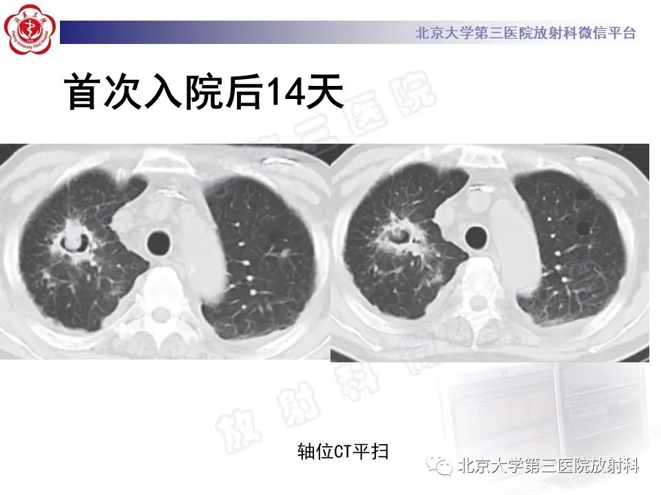 影像PPT - 【PPT】侵袭性肺曲霉菌病-13