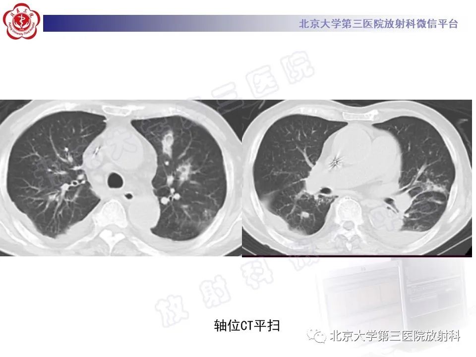 影像PPT - 【PPT】侵袭性肺曲霉菌病-14