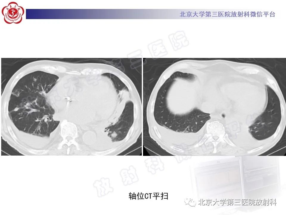 影像PPT - 【PPT】侵袭性肺曲霉菌病-15