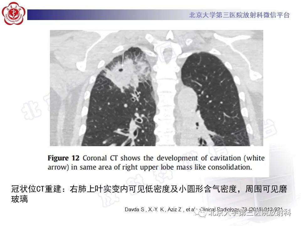 影像PPT - 【PPT】侵袭性肺曲霉菌病-28