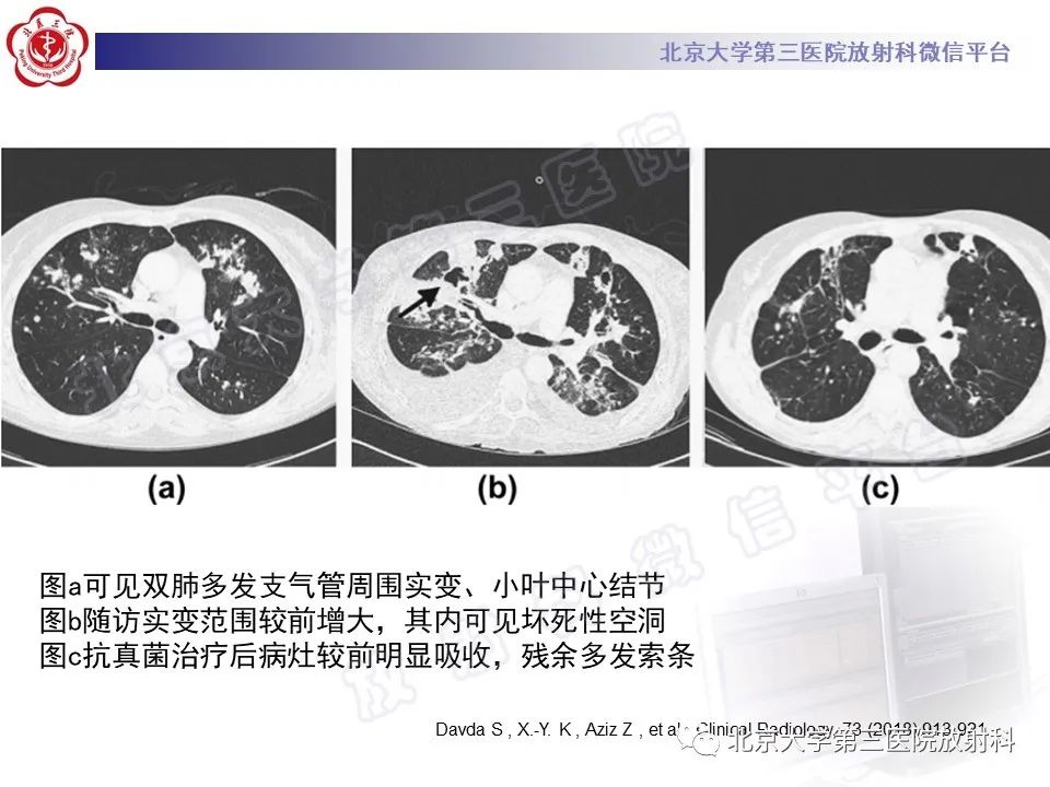 影像PPT - 【PPT】侵袭性肺曲霉菌病-32